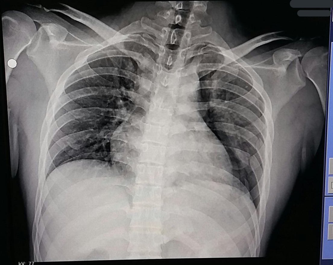 TORAX INESTABLE | Genially